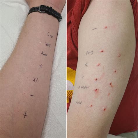 scratch test vs intradermal|Skin allergy test .